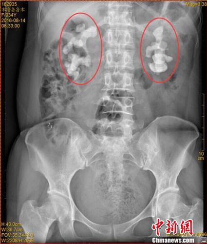 四川一女子喝生水30余年雙腎長10厘米巨型結石