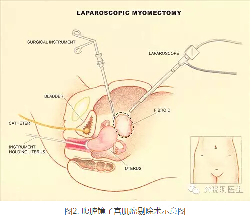 龔曉明：1/3女性都有的子宮肌瘤到底是啥