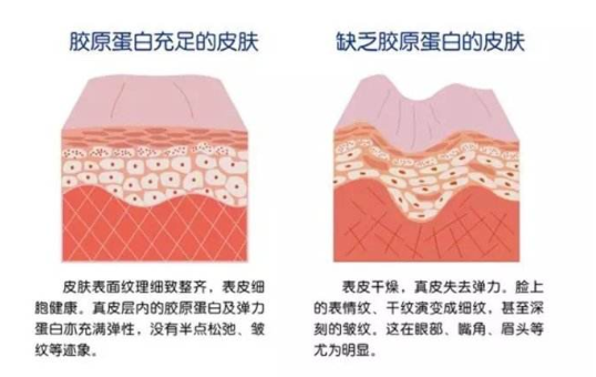 注射膠原蛋白真的能改善臉部皺紋？